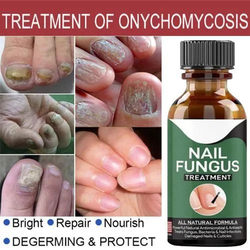 Fast Nail Fungal Treatments Nail Repair Essences Serum Care Treatments Foot Nail Fungus Removal Gel ₨92